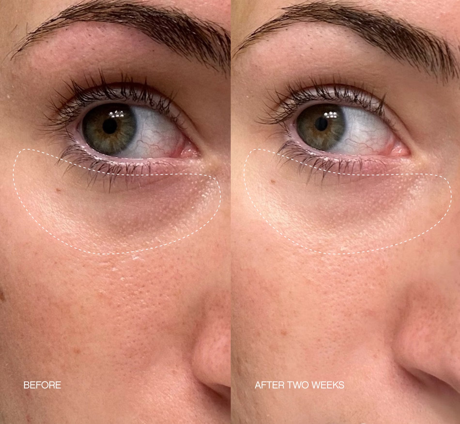 Dermvia™ Micro-Infusion Rejuvenating Patches