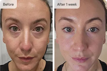 Dermvia™ Micro-Infusion Rejuvenating Patches